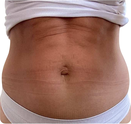 After Fat Reduction