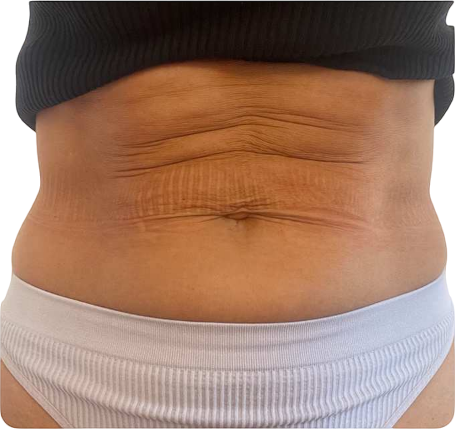 Before Fat Reduction
