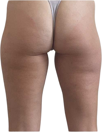 After Skin Tightening