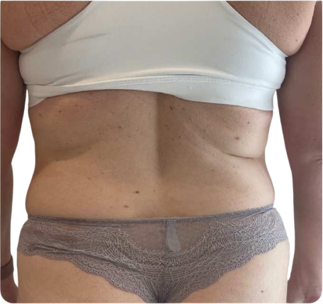 After Fat Reduction