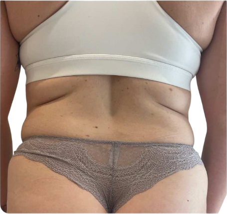Before Fat Reduction