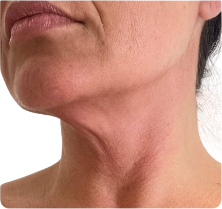 After Skin Tightening