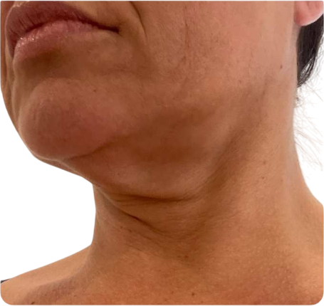 Before Skin Tightening
