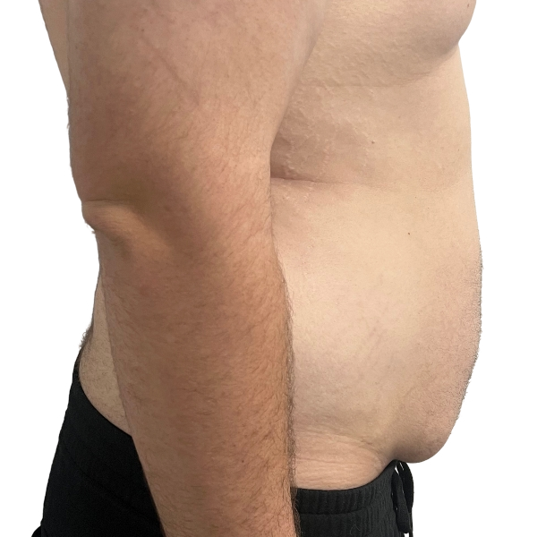 After Skin Tightening